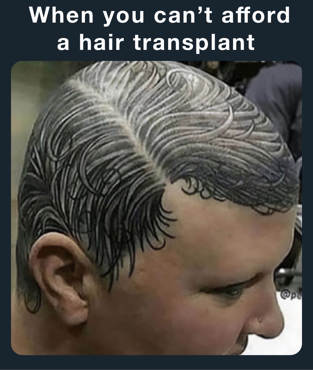 When you can’t afford 
a hair transplant