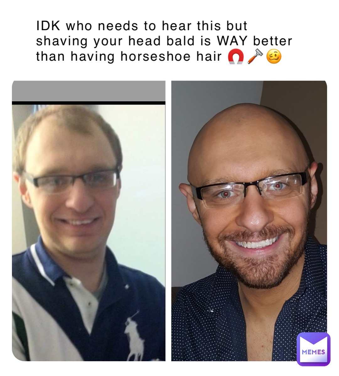 IDK who needs to hear this but shaving your head bald is WAY better than having horseshoe hair 🧲🪒🥴