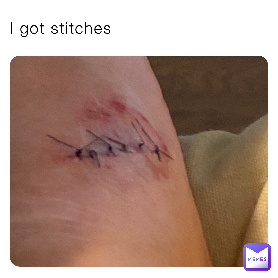 I got stitches
