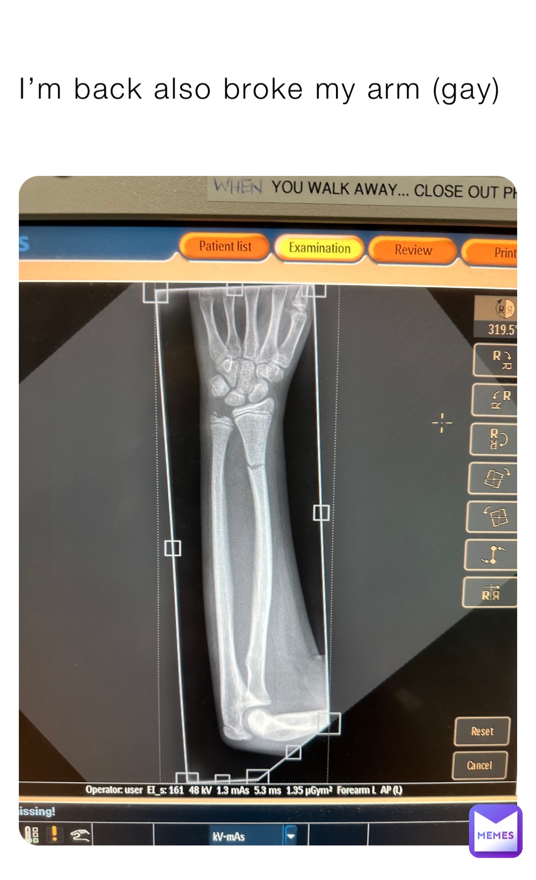 I’m back also broke my arm (gay)