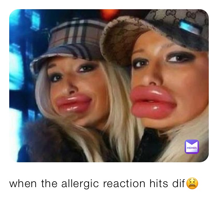 when the allergic reaction hits dif😫