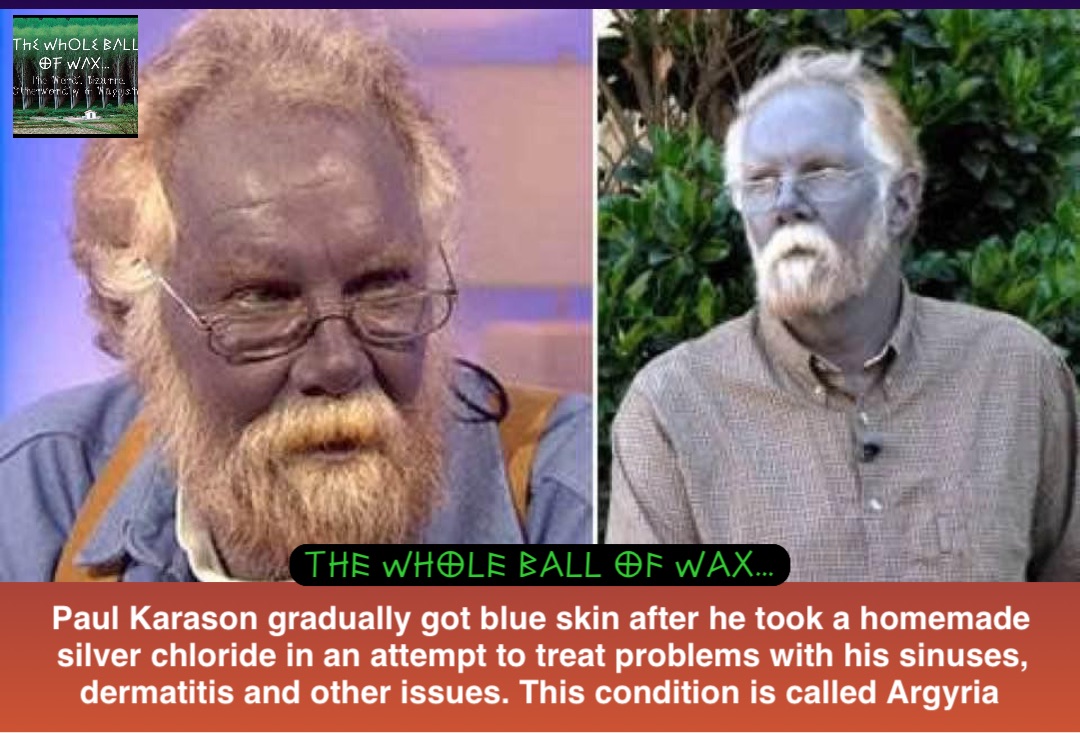 Double tap to edit Paul Karason gradually got blue skin after he took a homemade silver chloride in an attempt to treat problems with his sinuses, dermatitis and other issues. This condition is called Argyria