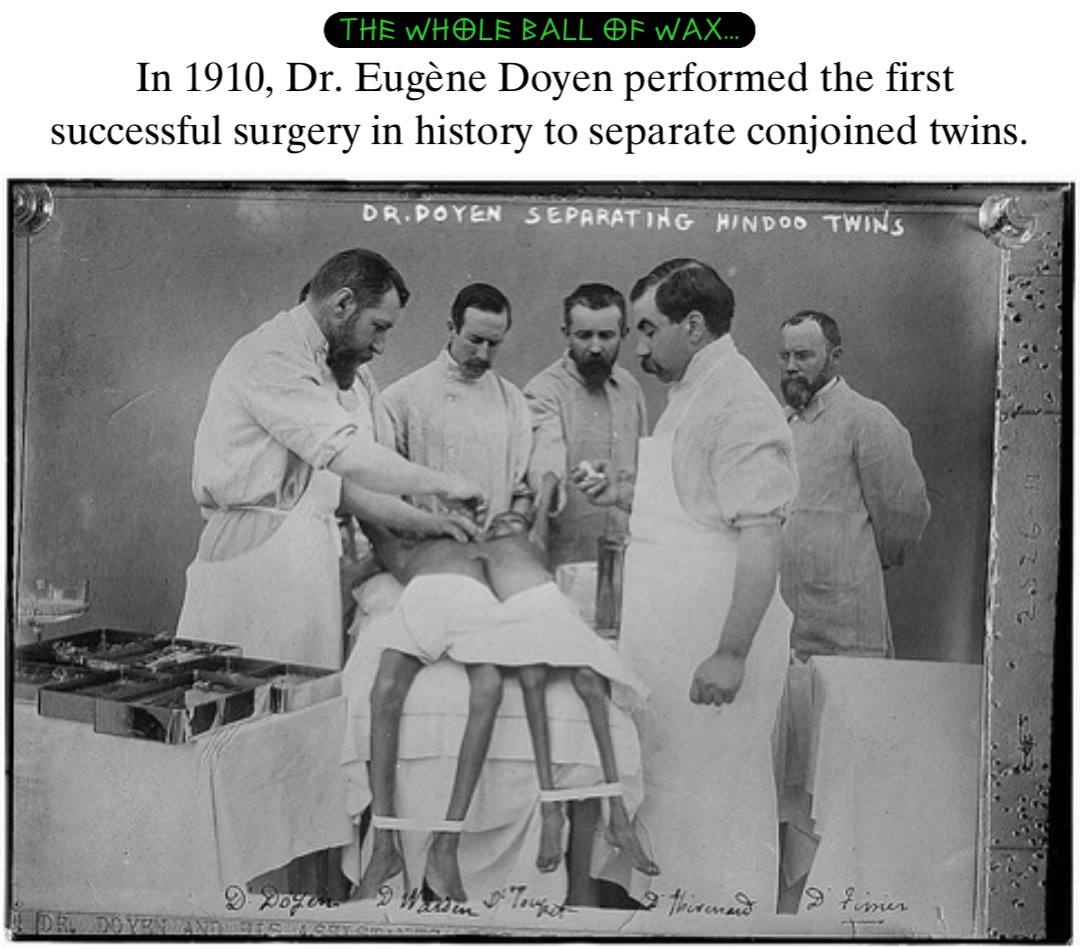 Double tap to edit In 1910, Dr. Eugène Doyen performed the first successful surgery in history to separate conjoined twins.