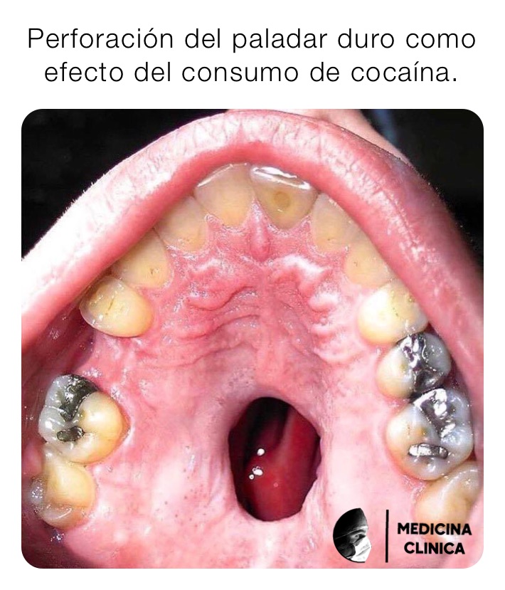 Perforación del paladar duro como efecto del consumo de cocaína.