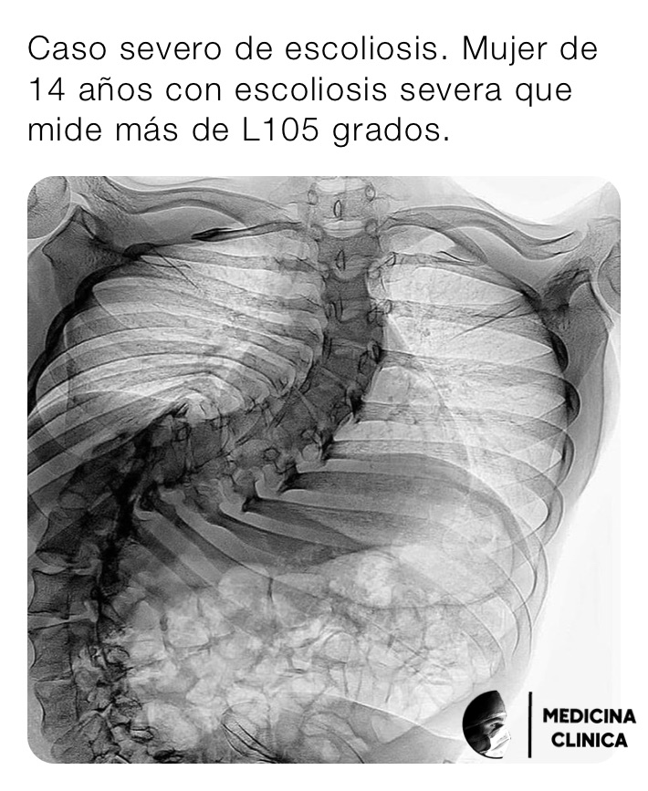 Caso severo de escoliosis. Mujer de 14 años con escoliosis severa que mide más de L105 grados.