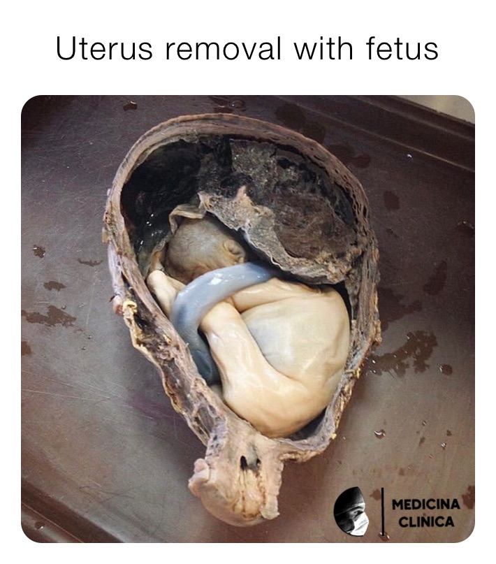 Uterus removal with fetus