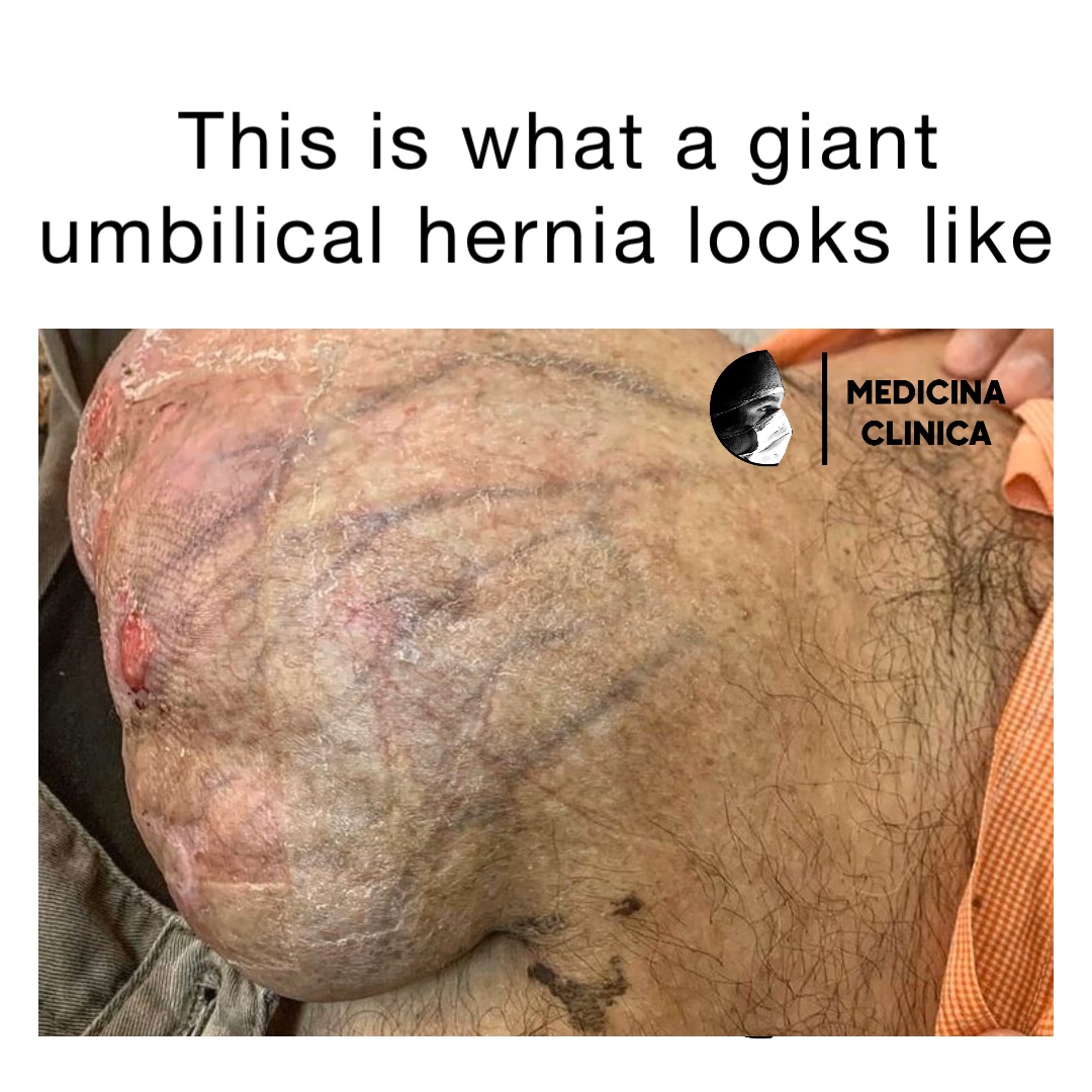 This is what a giant umbilical hernia looks like