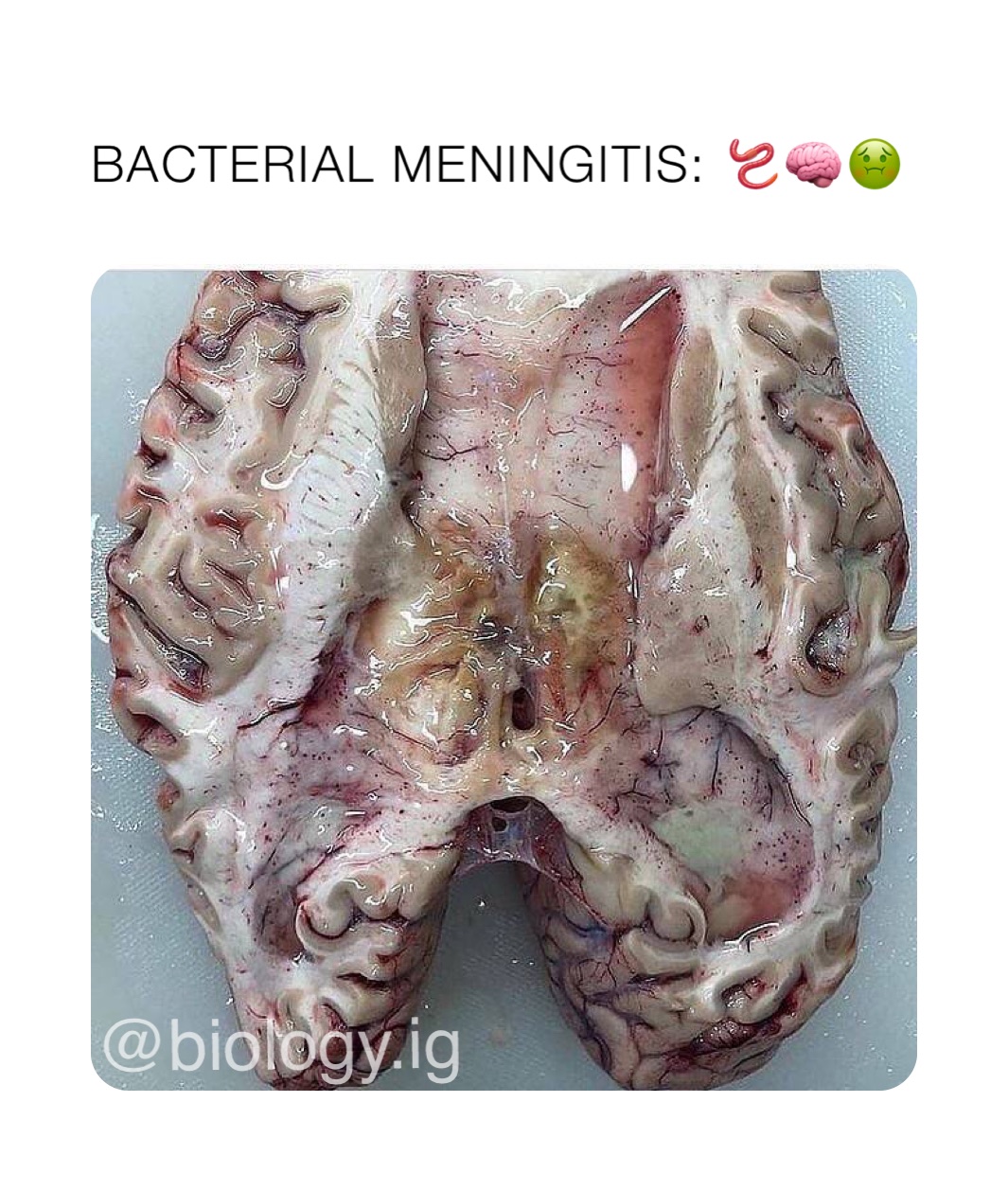BACTERIAL MENINGITIS: 🪱🧠🤢
