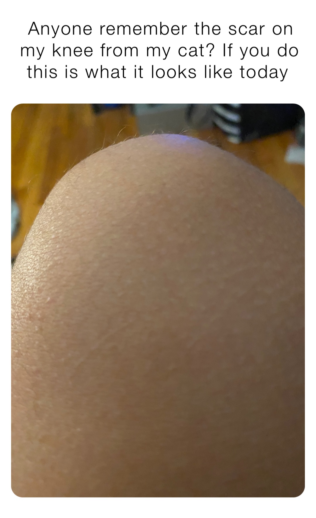 Anyone remember the scar on my knee from my cat? If you do this is what it looks like today