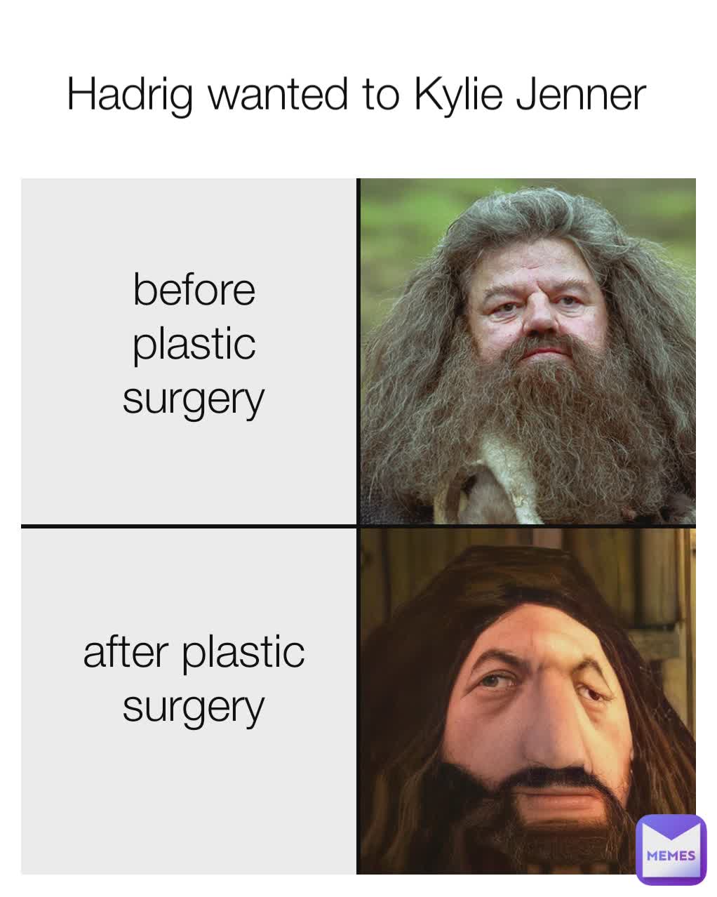 before plastic surgery after plastic surgery Hadrig wanted to Kylie Jenner