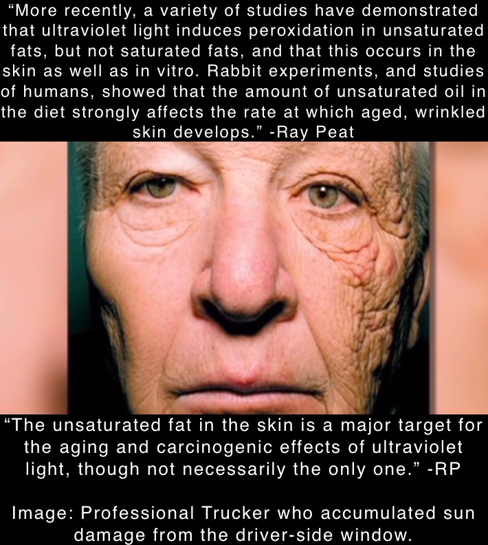 “More recently, a variety of studies have demonstrated that ultraviolet light induces peroxidation in unsaturated fats, but not saturated fats, and that this occurs in the skin as well as in vitro. Rabbit experiments, and studies of humans, showed that the amount of unsaturated oil in the diet strongly affects the rate at which aged, wrinkled skin develops.” -Ray Peat “The unsaturated fat in the skin is a major target for the aging and carcinogenic effects of ultraviolet light, though not necessarily the only one.” -RP

Image: Professional Trucker who accumulated sun damage from the driver-side window.