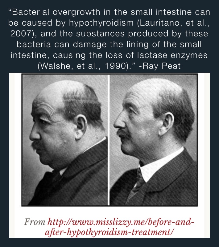 “Bacterial overgrowth in the small intestine can be caused by hypothyroidism (Lauritano, et al., 2007), and the substances produced by these bacteria can damage the lining of the small intestine, causing the loss of lactase enzymes (Walshe, et al., 1990).” -Ray Peat