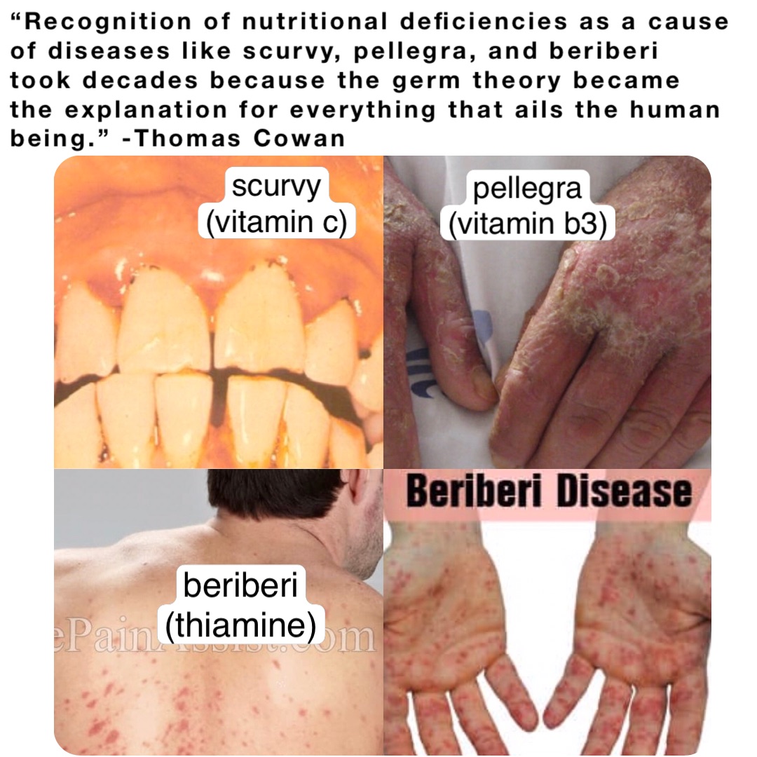 “Recognition of nutritional deficiencies as a cause of diseases like scurvy, pellegra, and beriberi took decades because the germ theory became the explanation for everything that ails the human being.” -Thomas Cowan scurvy
(vitamin c) pellegra
(vitamin b3) beriberi
(thiamine)