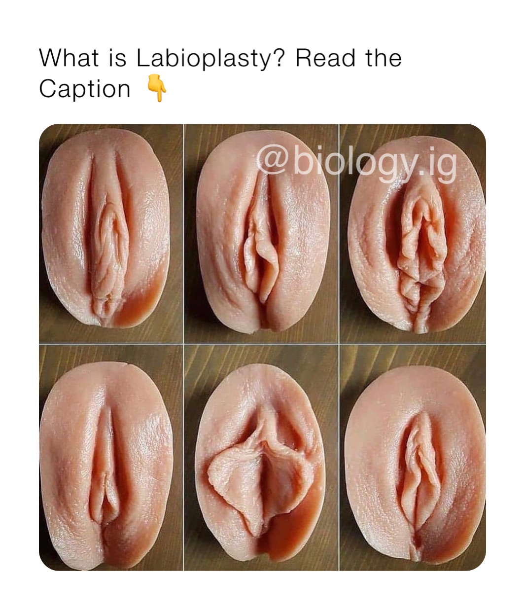 What is Labioplasty? Read the Caption 👇 