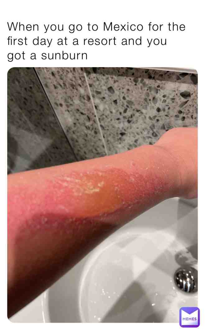 #sunburn #mexico # #help